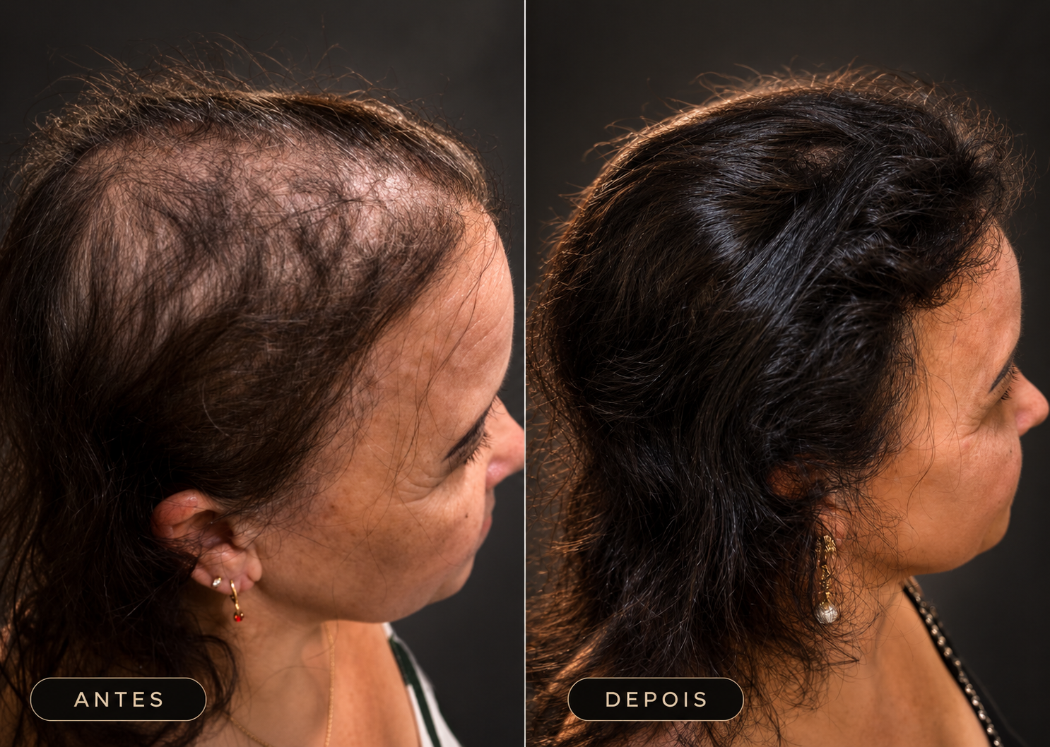 Antes e depois do acompanhamento capilar: fotografia fornecida pela Clínica Caiena, com antes à esquerda e depois à direita